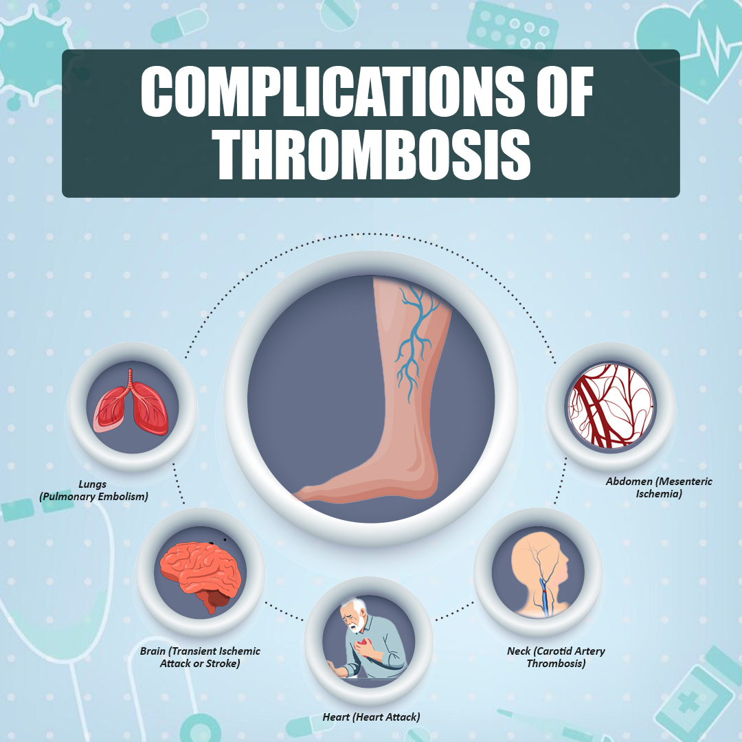 Complications of Thrombosis - insura.ae