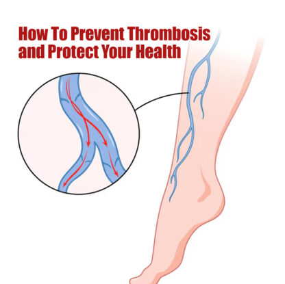 How To Prevent Thrombosis And Protect Your Health - insura.ae