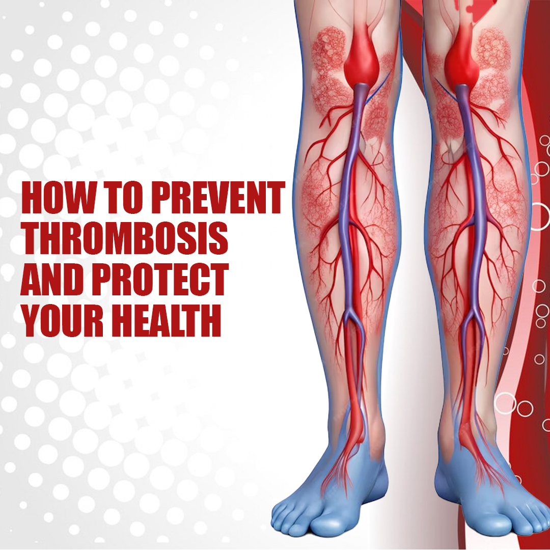 How To Prevent Thrombosis And Protect Your Health - insura.ae