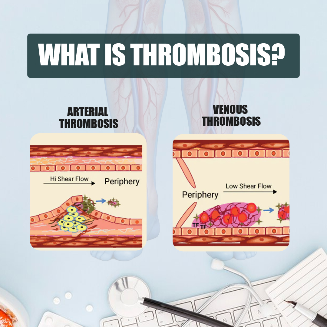 Types of Thrombosis and Their Symptoms - insura.ae